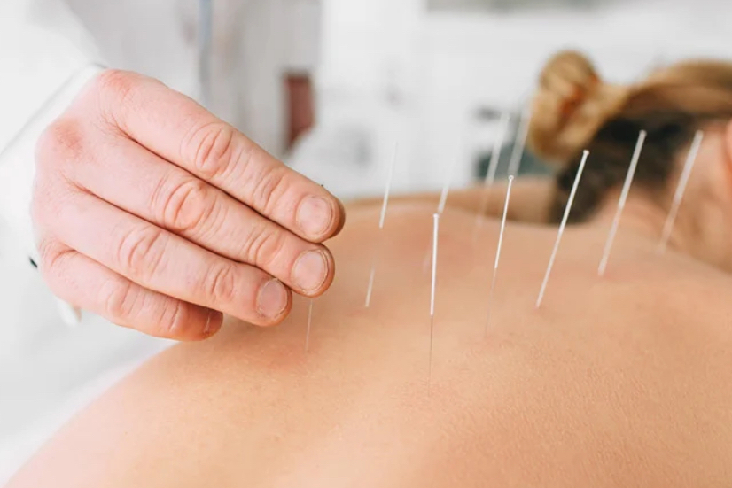 fertility acupuncture