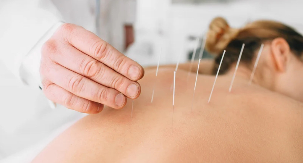 fertility acupuncture